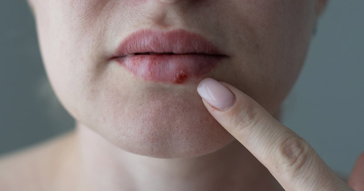 La FDA aprueba HOVILPRI, el antiviral oral que cambia el juego contra el herpes resistente