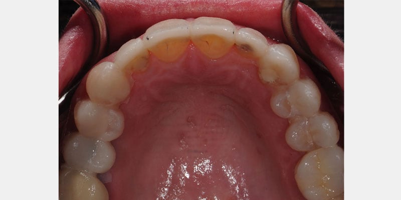 Carillas dentales: cuando el sellado falla y la filtración se cuela por los bordes